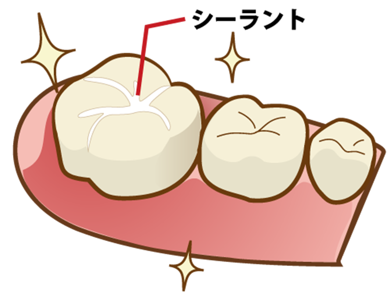 岩見沢市の歯医者で予防歯科